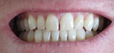 Elementos que devemos evitar para clarear os dentes