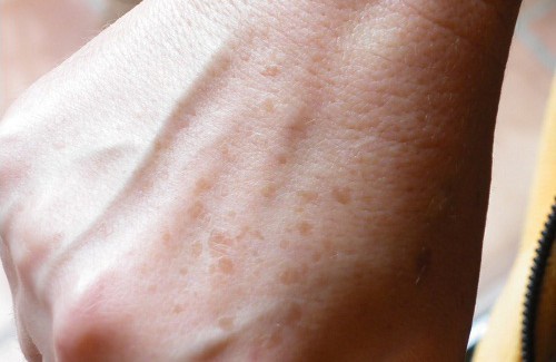 Como disfarçar ou eliminar as manchas e as sardas nas mãos?