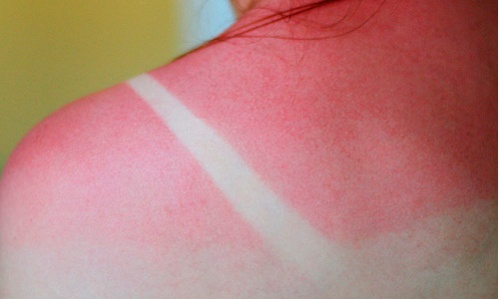 Como tratar a pele queimada pelo sol?