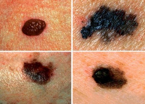 Aprenda a detectar um possível câncer de pele