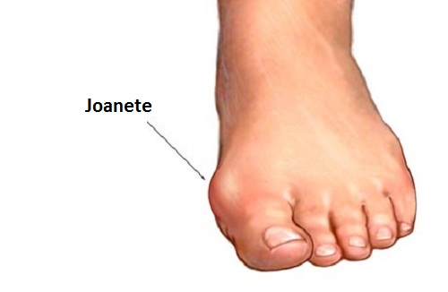 joanete