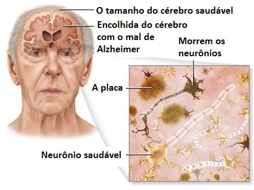 5 Conselhos para prevenir o mal de Alzheimer