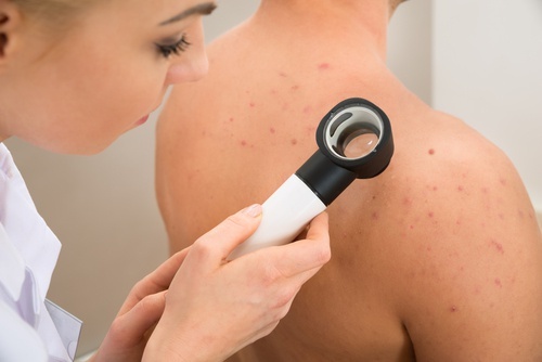 Remédios naturais para eliminar a acne no peito, ombros e costas