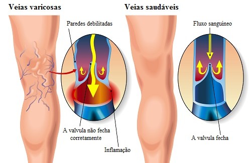 treatment-home-varices-500x325