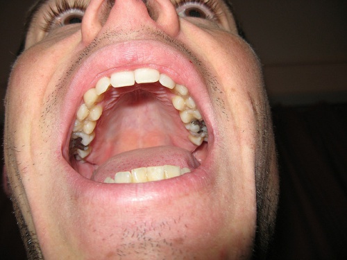 dentes-e-caries