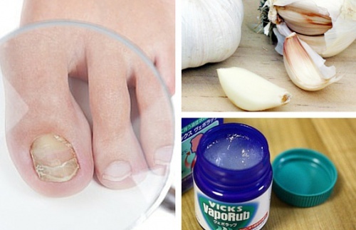 7 remédios caseiros para combater os fungos nas unhas dos pés e das mãos
