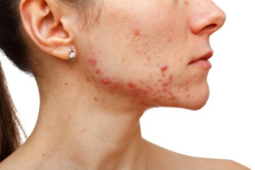 mel-para-combater-a-acne