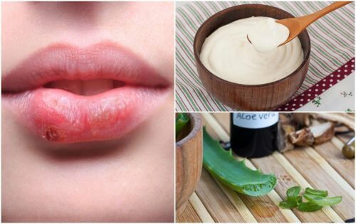 7 tratamentos naturais contra o herpes labial
